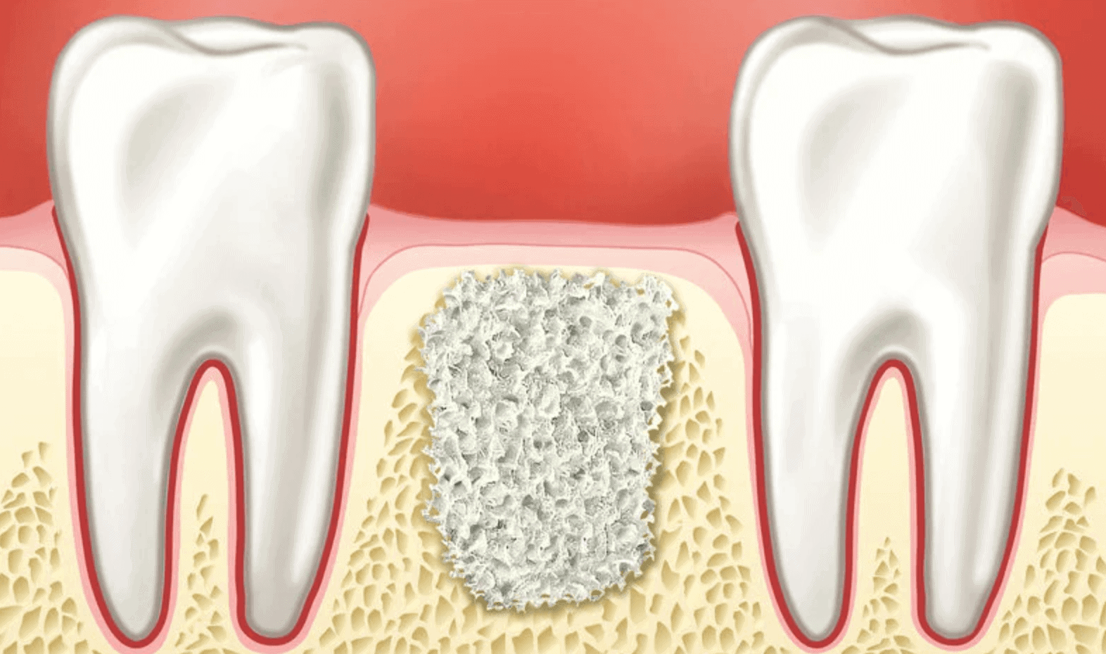 How Can Alveolar Socket Preservation Help You In Tooth Replacement? -  Advanced Dental Implant and TMJ Center