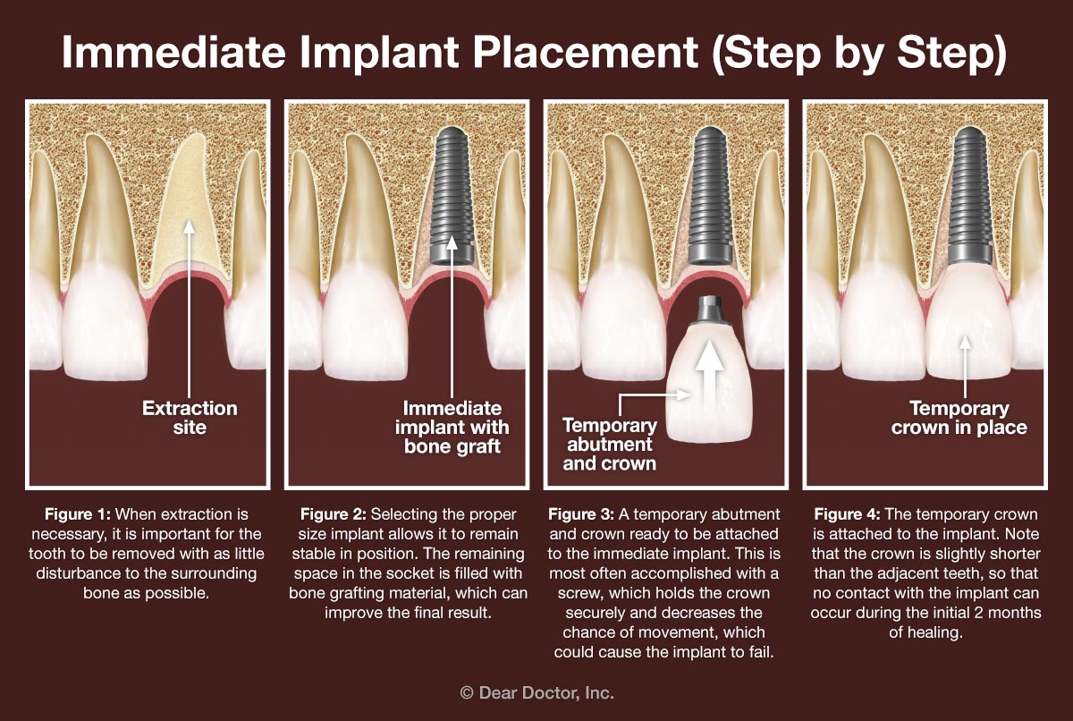 Immediate Dental Implants