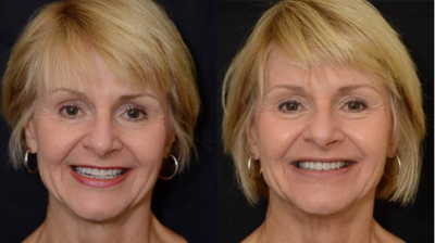 Full Mouth Rehabilitation Case 1 Photo