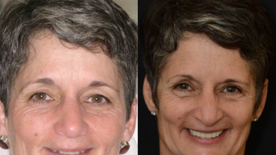 Full Mouth Rehabilitation Case 2 Photo