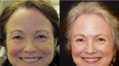 Full Mouth Rehabilitation Case 3 Photo