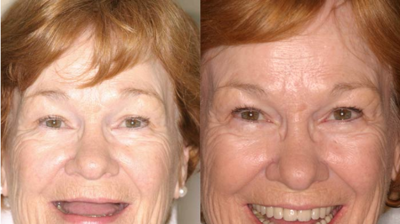 Dental Implants Case 4 Photo