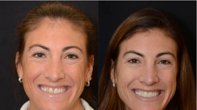 Porcelain Crowns for Front Teeth Case 1 Photo