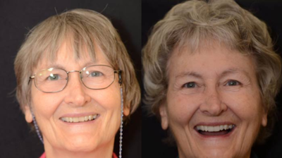 Porcelain Crowns for Front Teeth Case 2 Photo