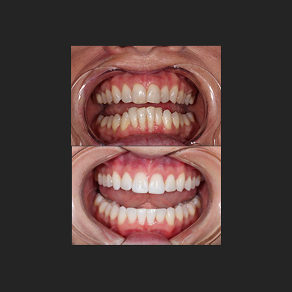 Clear Aligners