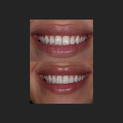 Cosmetic Bonding