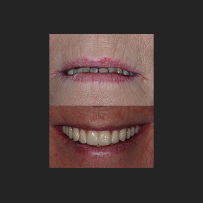 Full Arch Implants