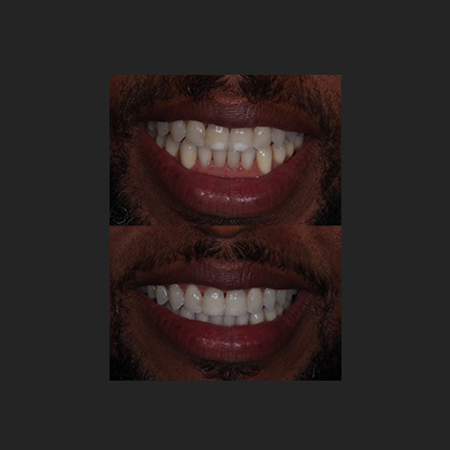 ICON White Spot Removal