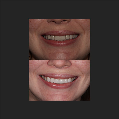 Veneers