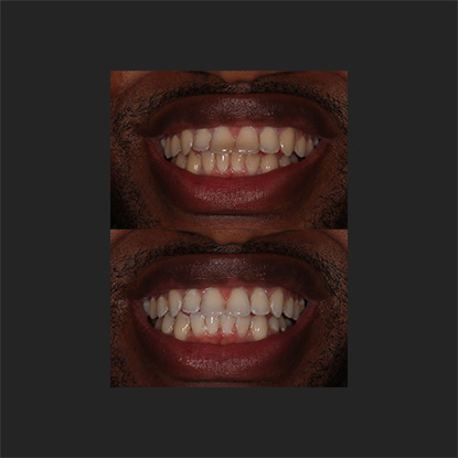 Whitening