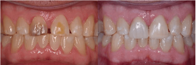 Composite Bonding of Front Teeth