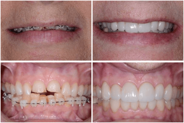 Porcelain Crowns for Front Teeth