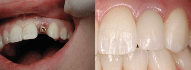 Dental Implants