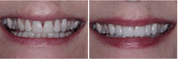 Porcelain Crowns for Front Teeth