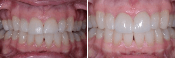 Porcelain Veneers Front Teeth