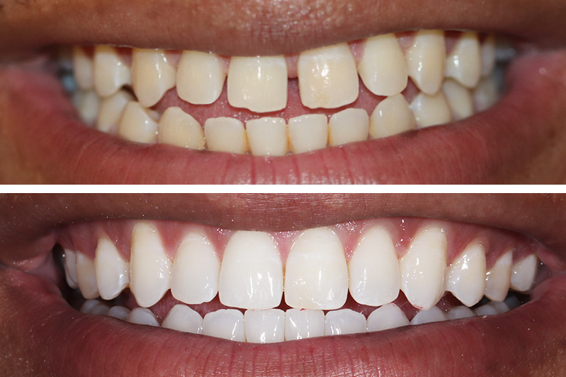 Clear Aligners