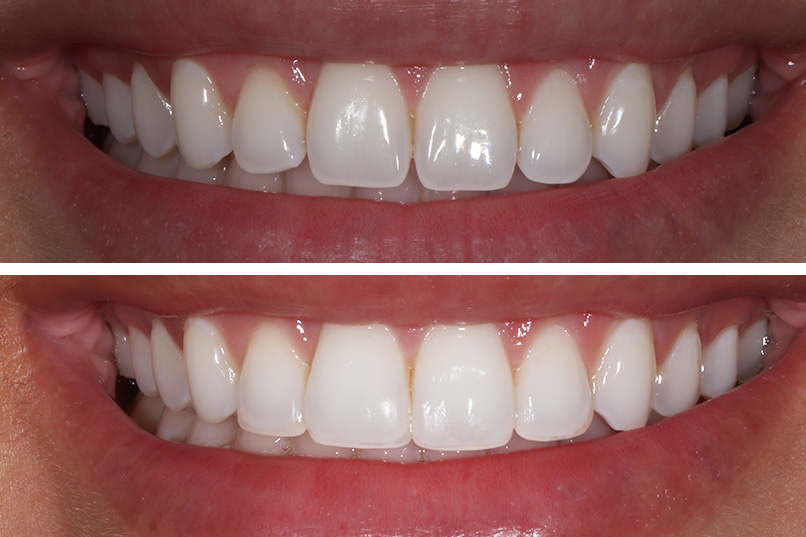 Cosmetic Bonding