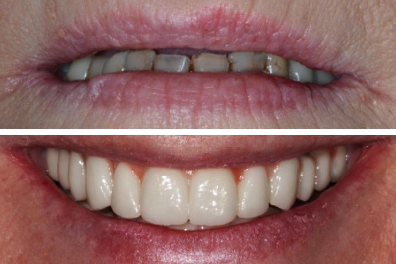 Full Arch Implants