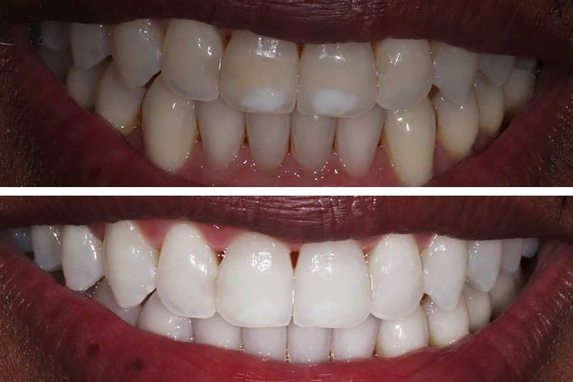 ICON White Spot Removal