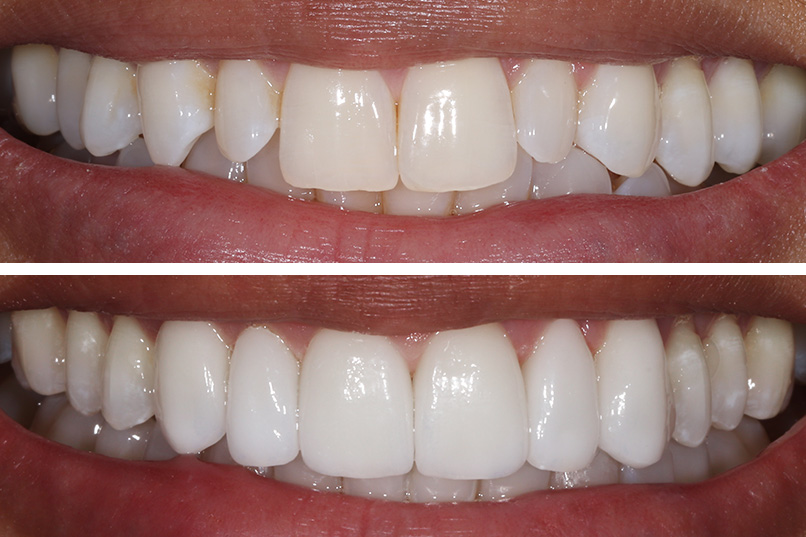 Veneers