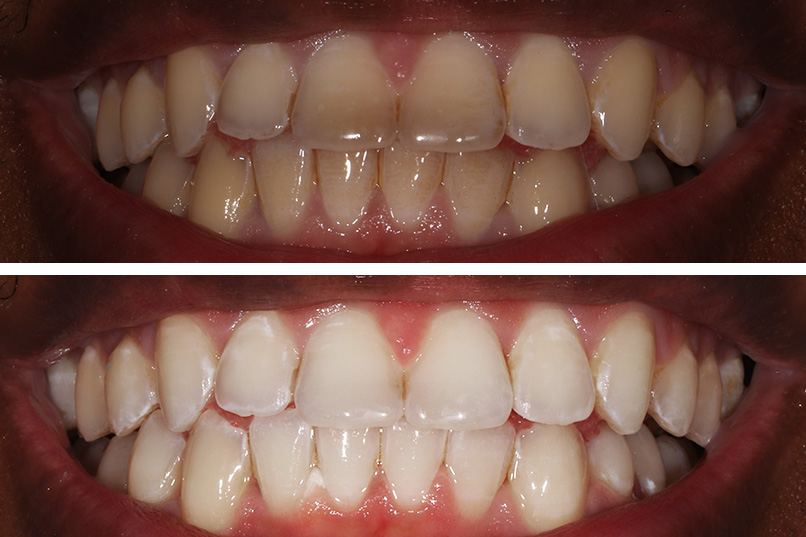 Whitening