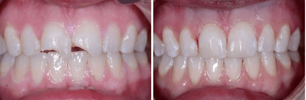 Composite Bonding of Front Teeth