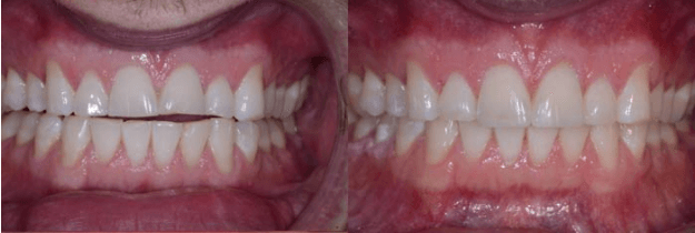 Composite Bonding of Front Teeth