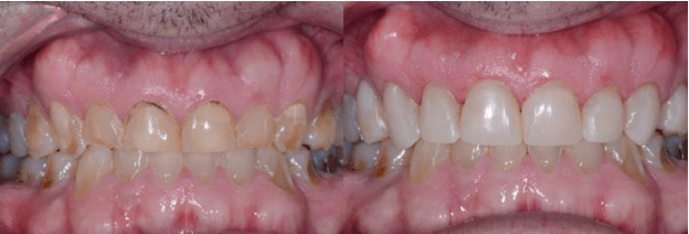 Composite Bonding of Front Teeth