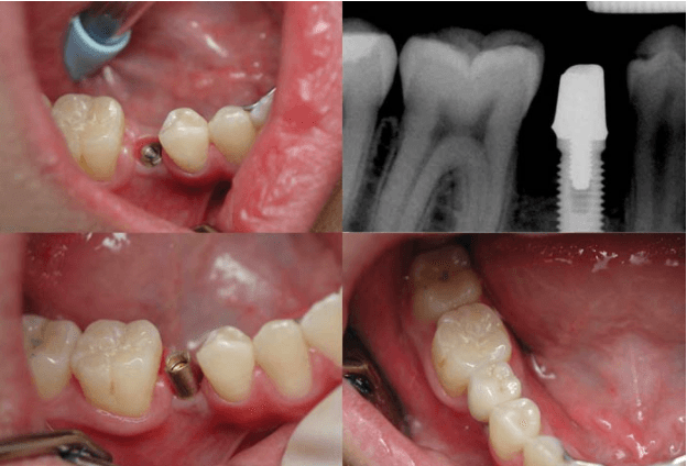 Dental Implants