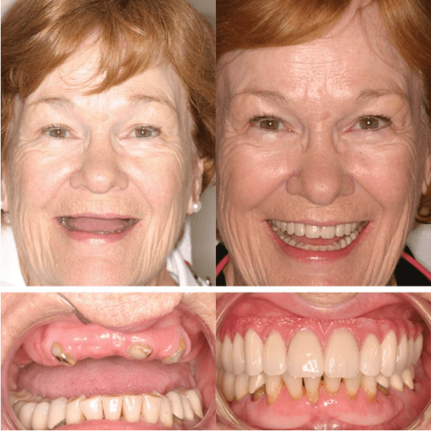 Dental Implants