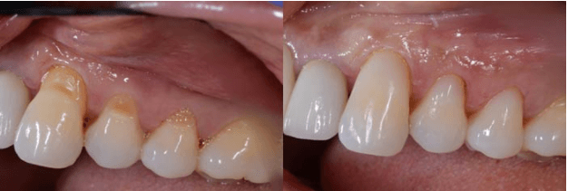 Gum Line Erosion and Composite Bonding