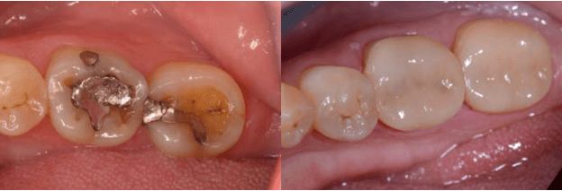 Porcelain Crowns for Back Teeth