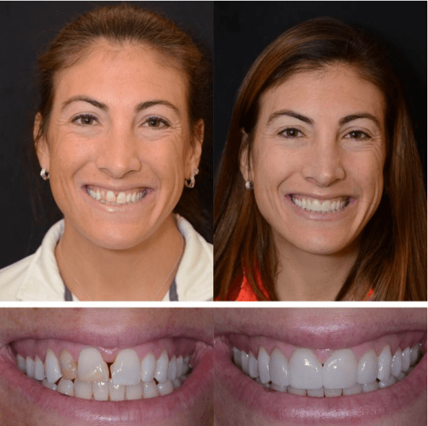 Porcelain Crowns for Front Teeth