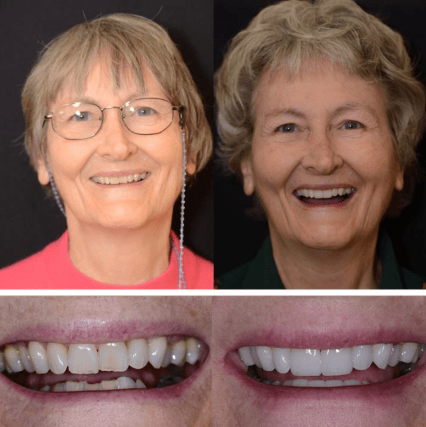 Porcelain Crowns for Front Teeth