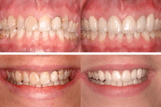 Porcelain Crowns for Front Teeth