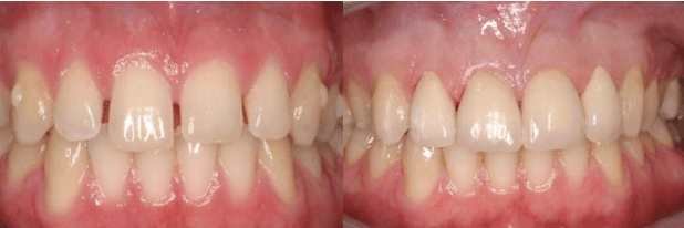 Porcelain Crowns for Front Teeth