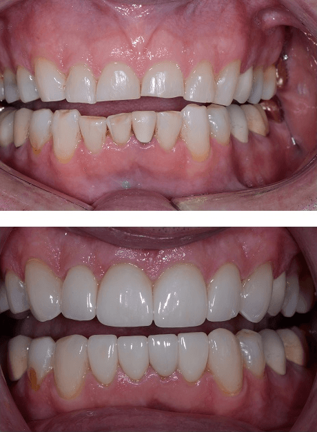 Porcelain Crowns for Front Teeth