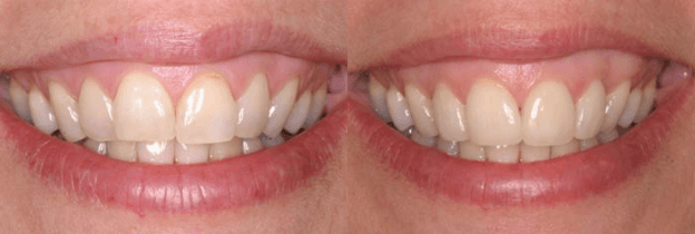 Porcelain Veneers