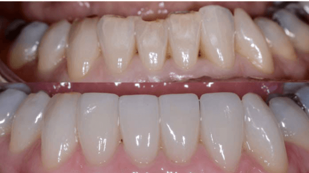 Porcelain Veneers