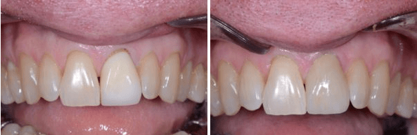 Single Porcelain Crown for Front Tooth