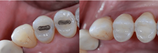 White Fillings